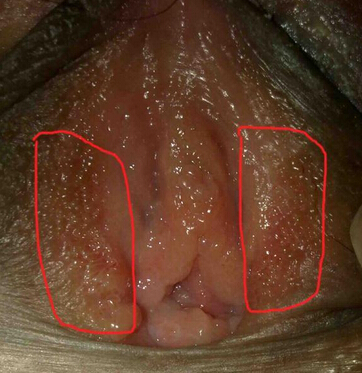 阴道尖锐湿疣早期症状图
