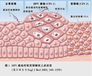 hpv可引起尖锐湿疣或宫颈癌